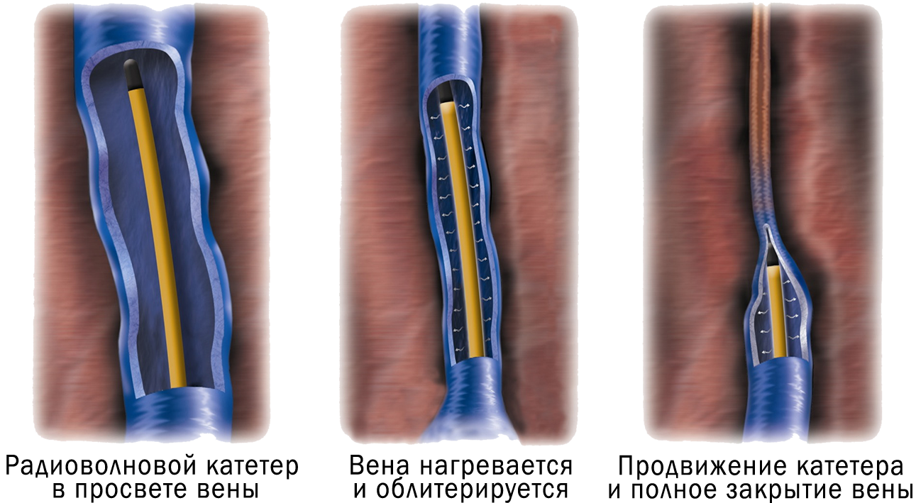 Сколько дней можно катетер в вене. Лазерная эндовазальная облитерация вен нижних конечностей. Радиочастотная коагуляция вен нижних конечностей. Эндовазальная лазерная коагуляция варикозных вен.